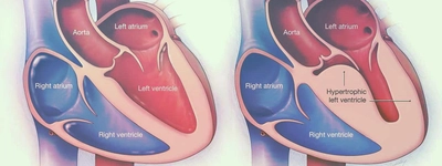 A ecocardiografia 2D na cardiomiopatia hipertrofica.